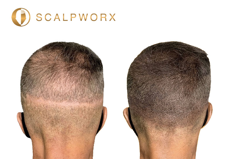 Hair transplant strip scar camouflage SMP before and after at Scalpworx