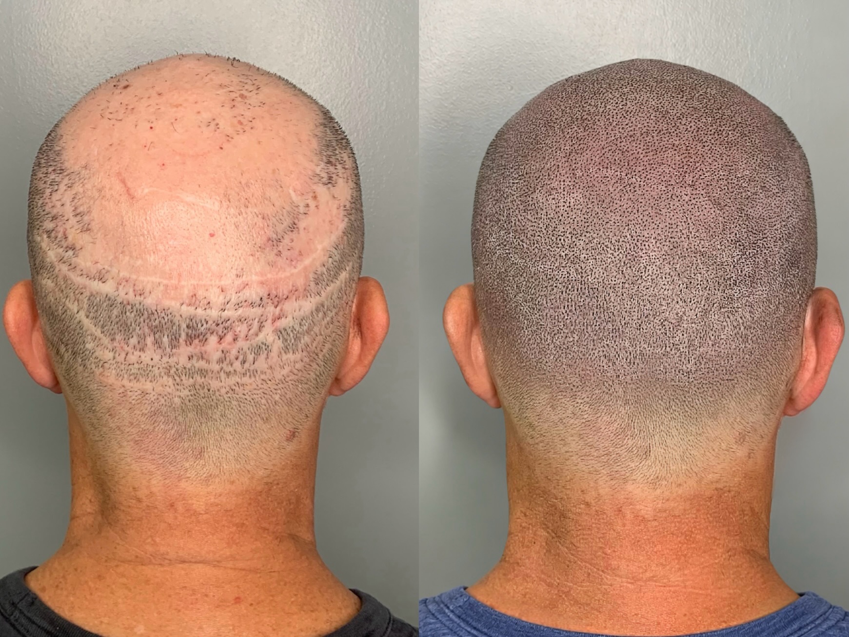 SMP for Scar Camouflage: Enhancing Confidence