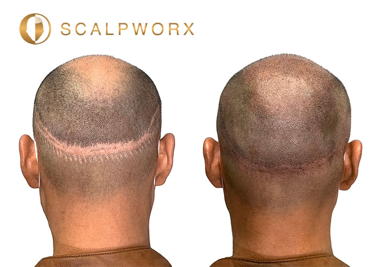 SMP for Scar Camouflage: Enhancing Confidence