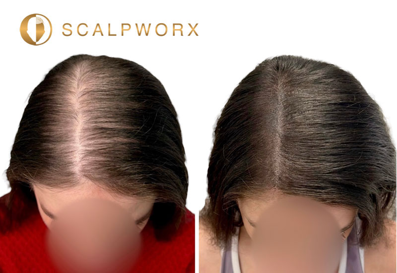 SMP for Traction Alopecia & Textured Hair