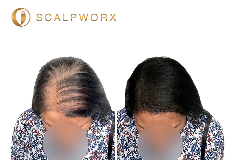 Women's scalp micropigmentation result softening scalp visibility at Scalpworx