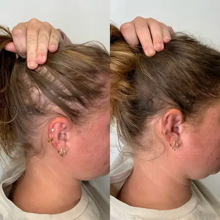 Scalpworx before and after result