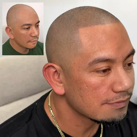 Scalpworx before and after result