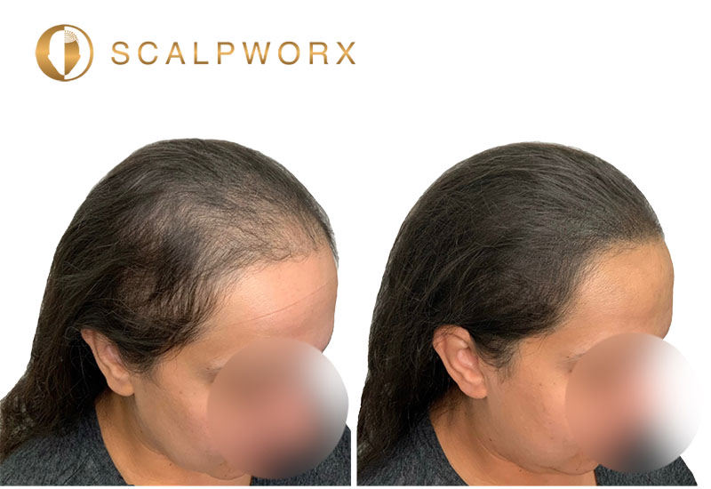 SMP for Women: Redefining Hair Loss Solutions