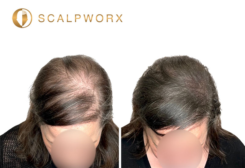 Woman's thinning hair before and after scalp micropigmentation for added density
