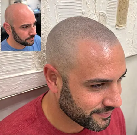 Scalpworx before and after result
