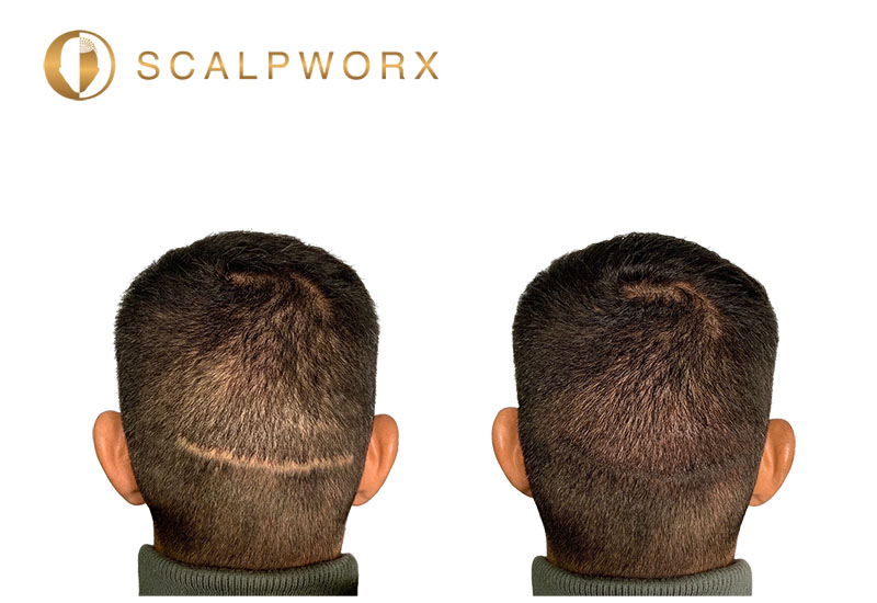 Scalp scar camouflage SMP before and after at Scalpworx