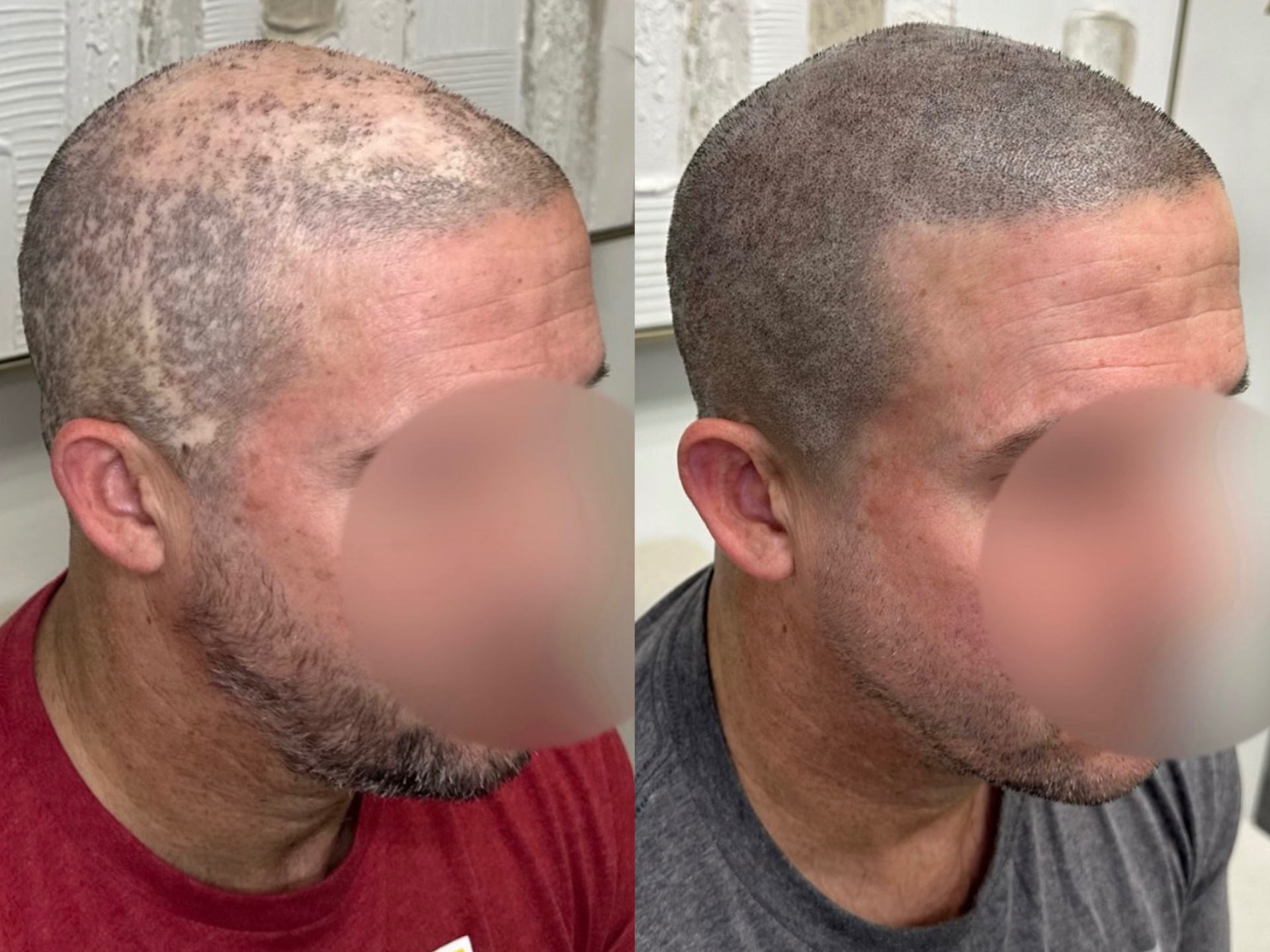 Restoring Hair and Confidence