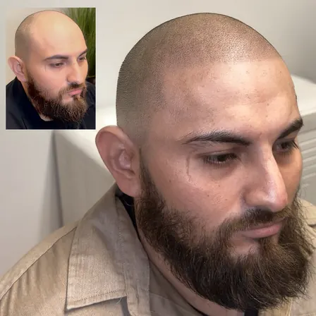 Scalpworx before and after result