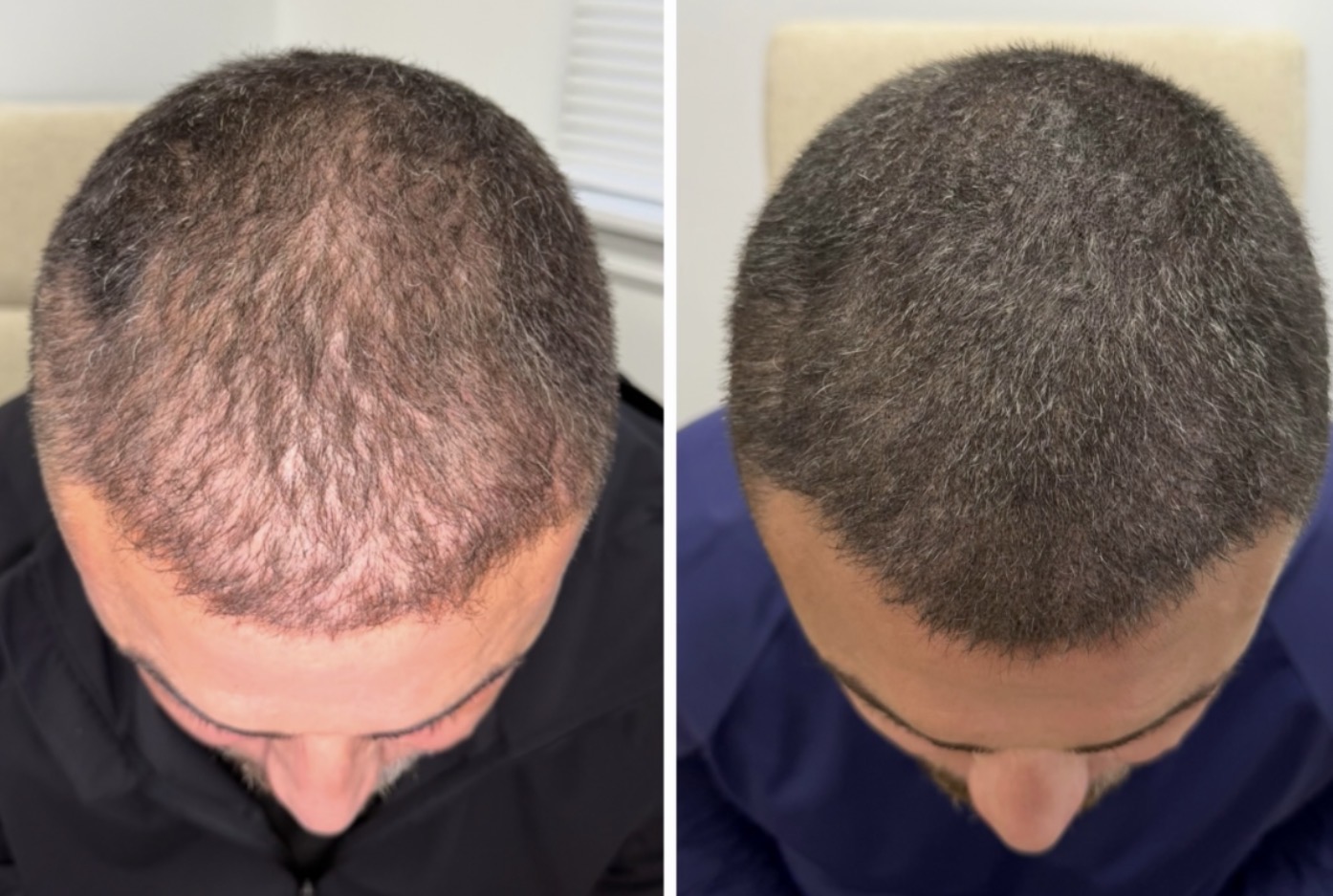 SMP for Hair Density: Understanding the Process