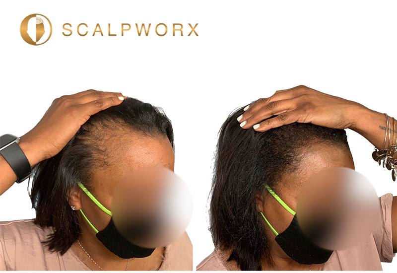 Women's hairline and temple SMP before and after at Scalpworx