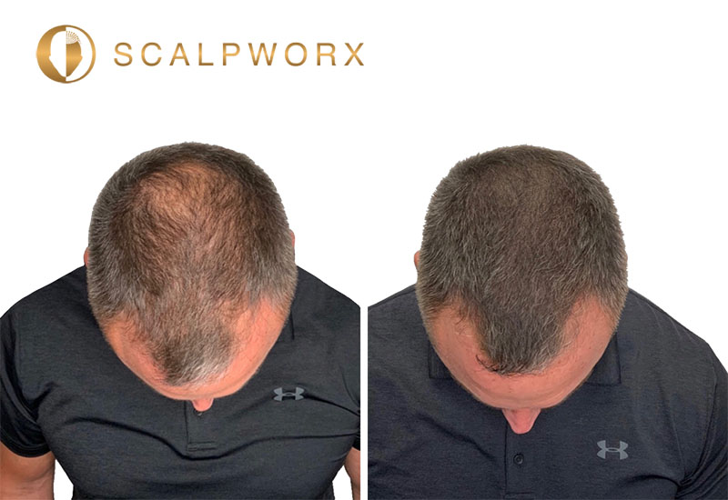 Hair density SMP before and after at Scalpworx